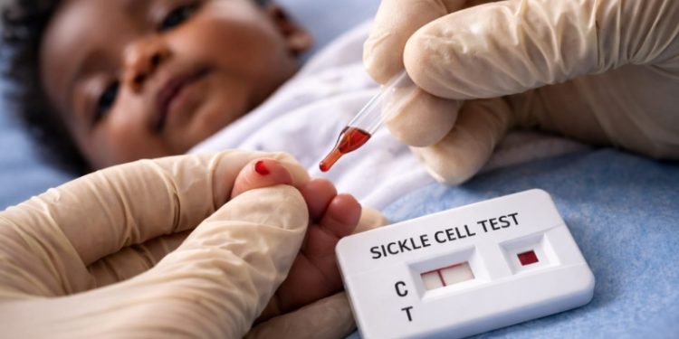 Uganda Intensifies Sickle Cell Screening as 9,000 Children Die Annually